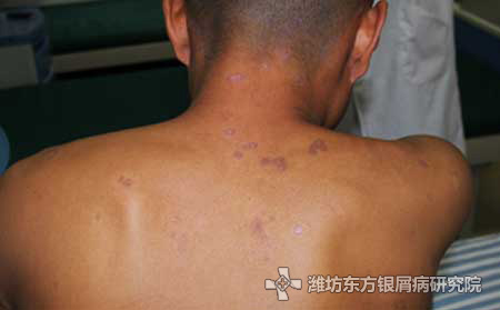 头部银屑病病因