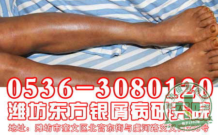 毛囊性银屑病有什么症状表现