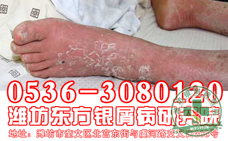 秋季银屑病预防原则是什么？