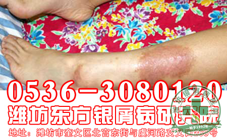 秋季银屑病患者如何进行皮肤保养