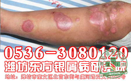 银屑病预防主要体现在哪几个方面?
