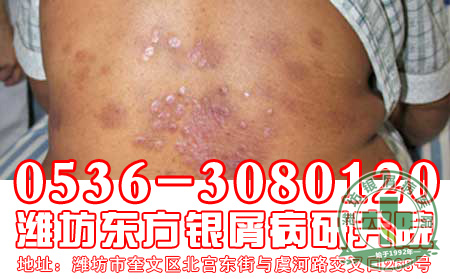 重症银屑病还能治可以吗