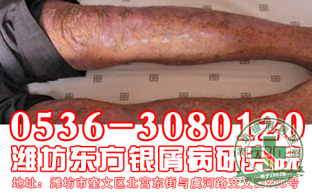 秋冬季节如何预防银屑病？
