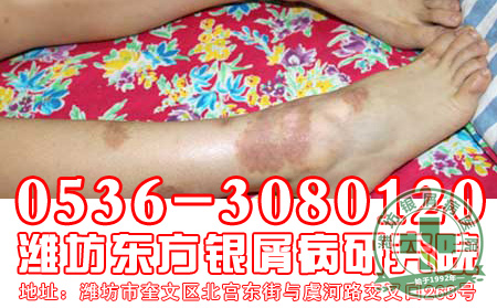 女性牛皮癣患者护理方法介绍
