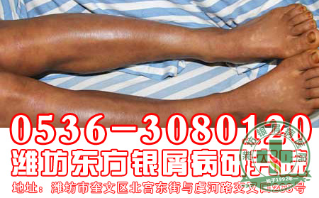 秋季银屑病护理应该注意哪些问题？