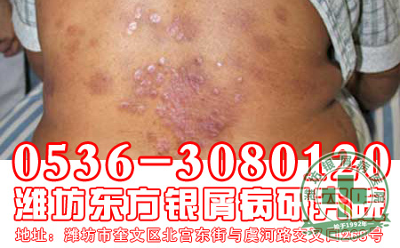 牛皮癣为什么反复发作？