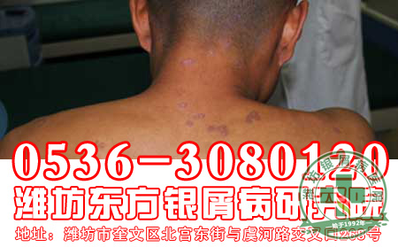 头上长了银屑病怎么治