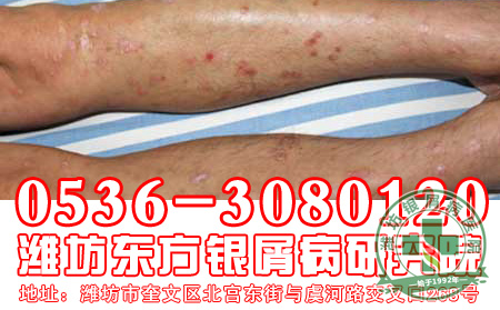 非典型银屑病症状有哪些？
