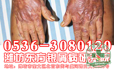 关节型牛皮癣治疗可以的方法