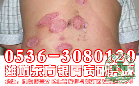 非典型银屑病的两种症状类型