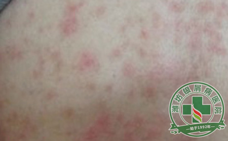 夏季寻常型银屑病的预防措施有哪些