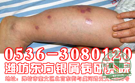 银屑病患者经常蜕皮应该如何护理?