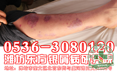 浅谈银屑病的五大症状特征