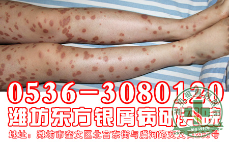 患者如何做才能预防银屑病反复复发