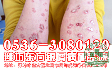 青少年寻常型银屑病症状介绍