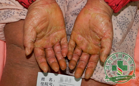 如何应对顽固性牛皮癣