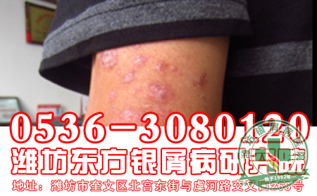 进行期的牛皮癣患者要注意什么呢?