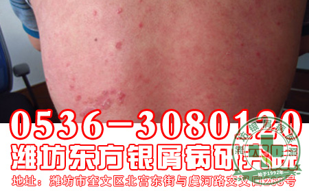 寻常型牛皮癣如何科学的护理呢?