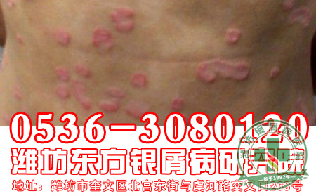 牛皮癣治疗药物有哪些
