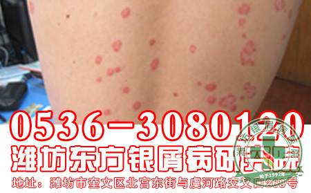 老年牛皮癣患者在深秋季节如何护理呢?
