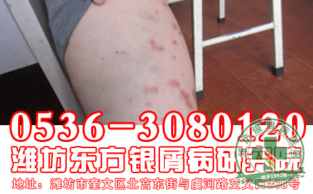 儿童牛皮癣有什么特征吗?