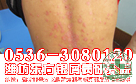 老年牛皮癣患者如何做可以护理工作呢?