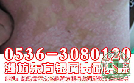 早期的牛皮癣应该如何护理呢?
