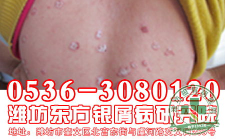 银屑病的进行期有什么具体症状呢?