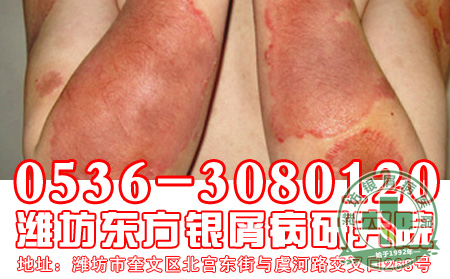 牛皮癣症状消失了还需要用药吗?