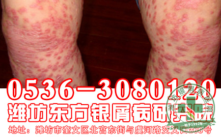 牛皮癣反复发作怎么办