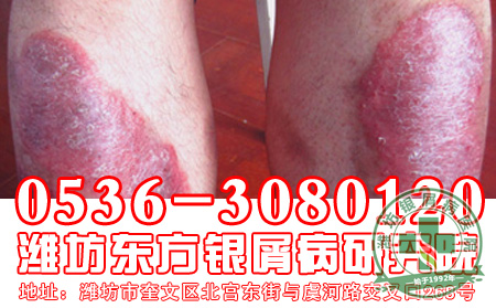 牛皮癣外用药使用注意的事项