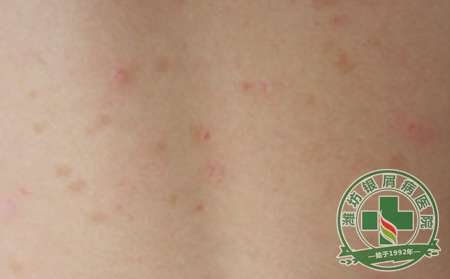 生活中容易诱发银屑病的坏习惯有哪些