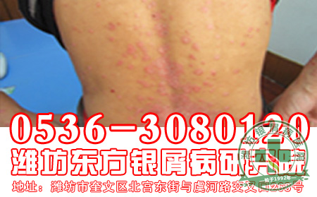 女性牛皮癣患者为了健康需要舍弃什么呢