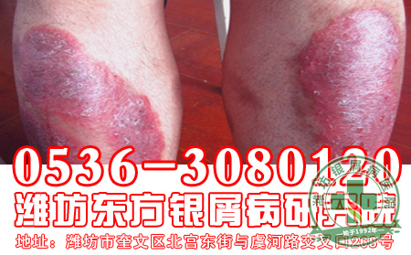  讲解：如何应对亦敌亦友的牛皮癣
