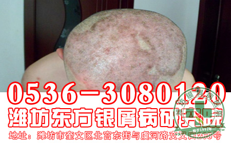 牛皮癣患者秋季护肤进行时