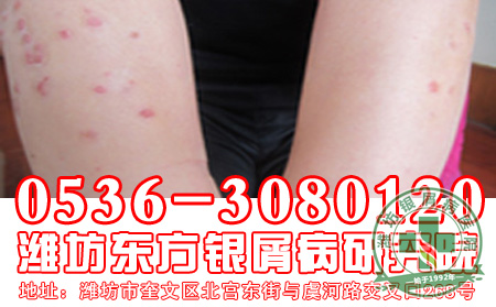 银屑病患者病情可以转的迹象有哪些