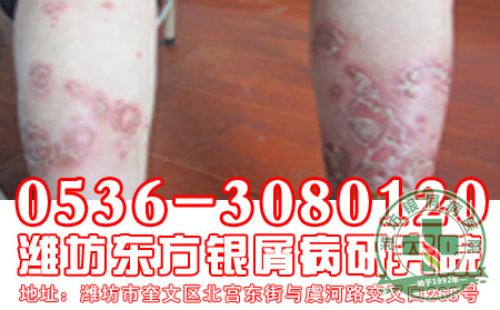 牛皮癣患者的家庭养护