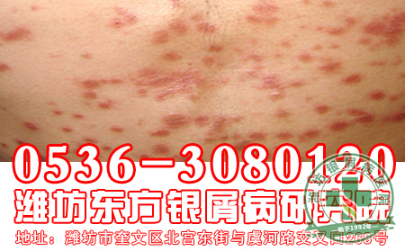 牛皮癣患者关注：国庆小长假，你准备可以了吗