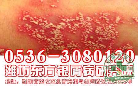牛皮癣患者关注：多做有氧运动身体可以