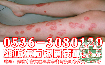 “天兔”来袭，银屑病防复发迫在眉睫