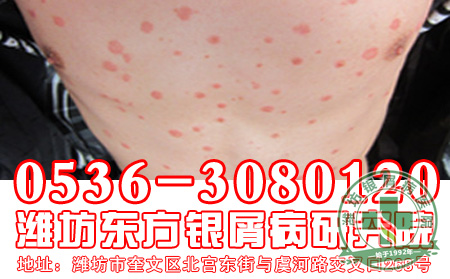 牛皮癣预防要从哪几个方面着手