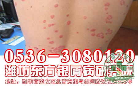 银屑病患者如何保健呢