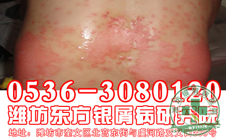 为什么说牛皮癣是一种身心性疾病
