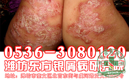 银屑病为什么长期治疗不可以