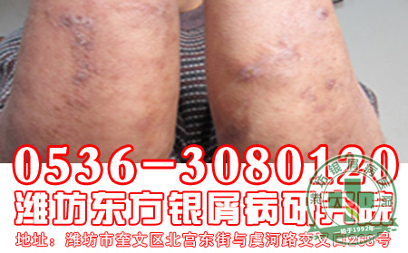 初秋季节，牛皮癣患者应该如何保健