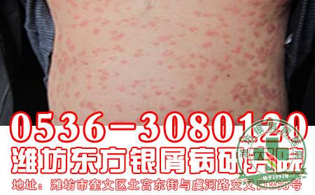 老年牛皮癣有什么特点吗