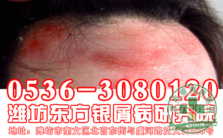 职场银屑病患者如何减压呢?
