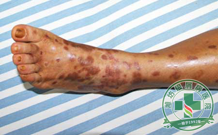 春暖花开,美丽女人相约济南牛皮癣医院