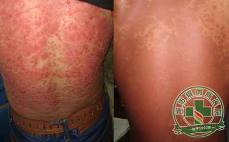 银屑病患者能喝功能型饮料吗?