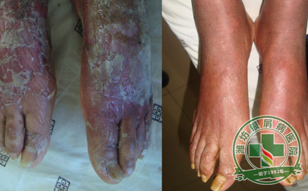 浅谈夏季牛皮癣护理注意事项